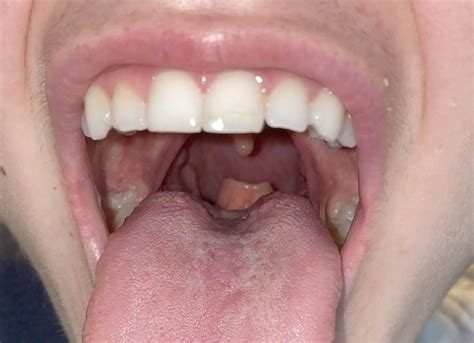 visible epiglottis in children.